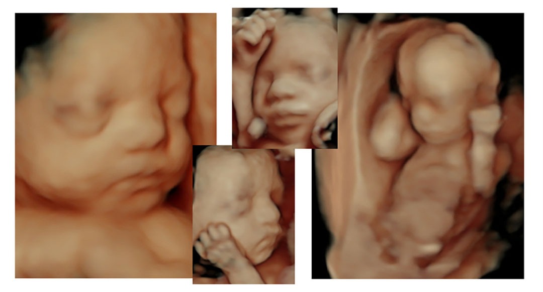 Baby ultrasound Images