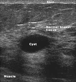 Breast Ultrasound Bozeman MT Breast Ultrasound Bozeman MT