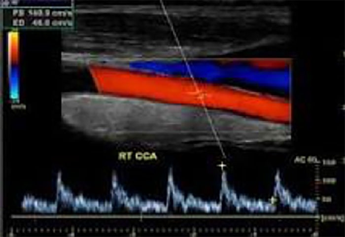 Carotid Ultrasound Bozeman MT