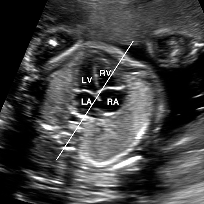 Fetal Echocardiography Bozeman MT