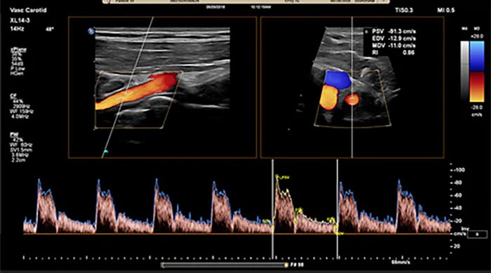 Vascular Ultrasound Bozeman MT