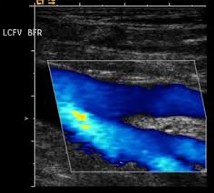 Venous Ultrasound Bozeman MT